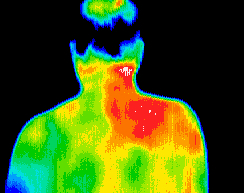 Thermal Image Showing Shoulder Pain